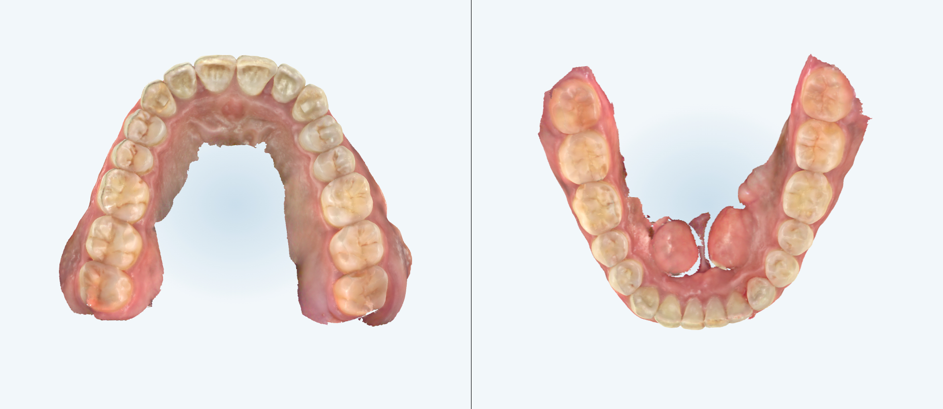 Dental expansion treatment comparison case 2 after